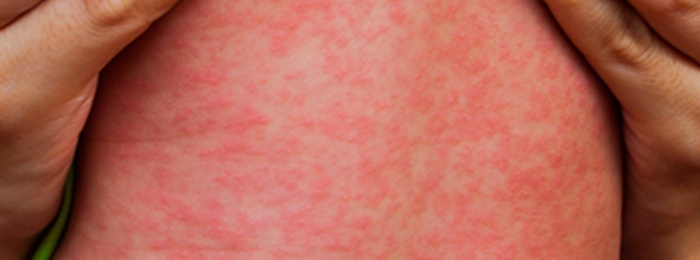Com sintomas parecidos, dengue e sarampo não devem ser confundidos